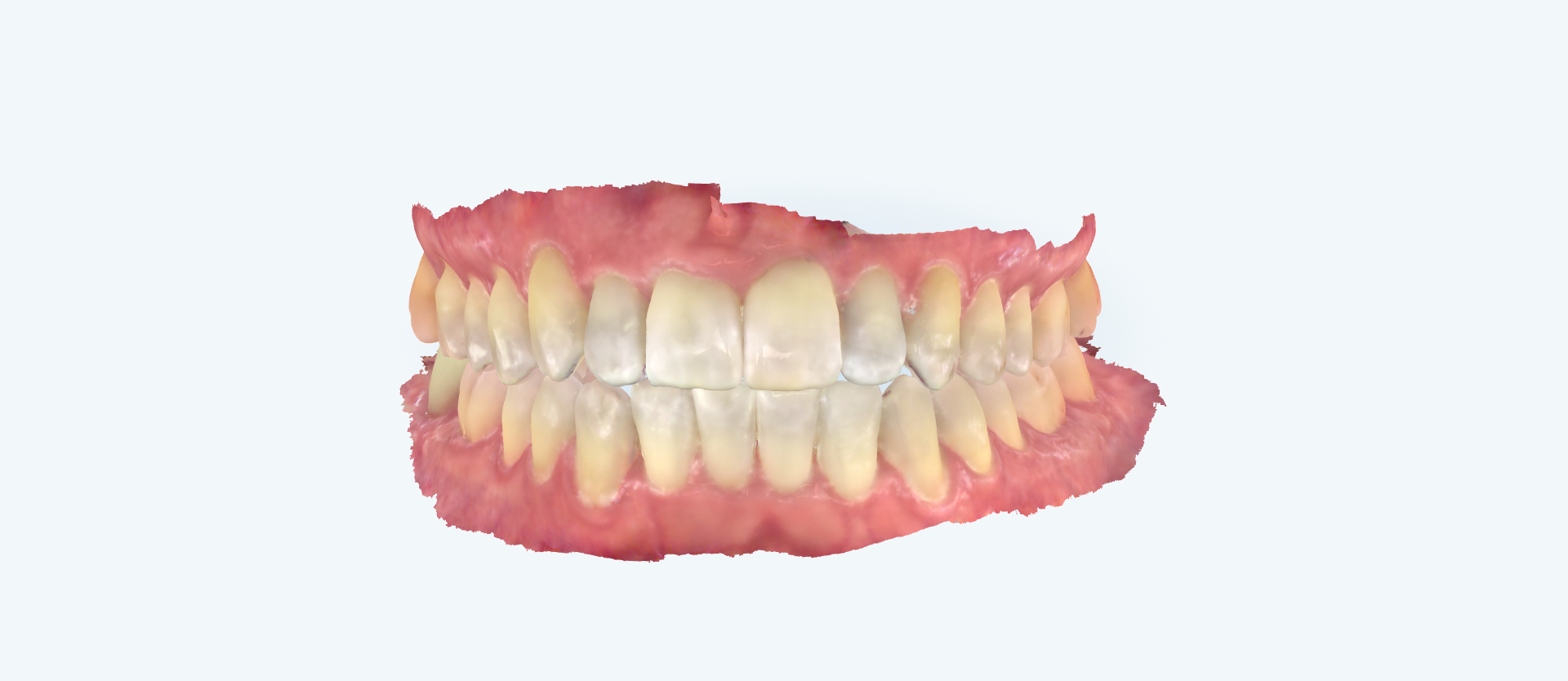 Crossbite treatment comparison case 3 after